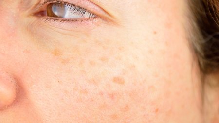 BIODERMA piel de la cara pigmentada con manchas BIODERMA piel de la cara pigmentada con manchas